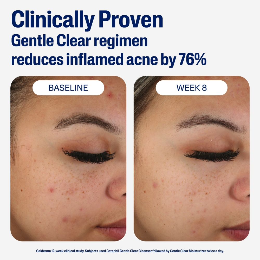 Cetaphil Mattifying Acne Moisturizer 89 ml
